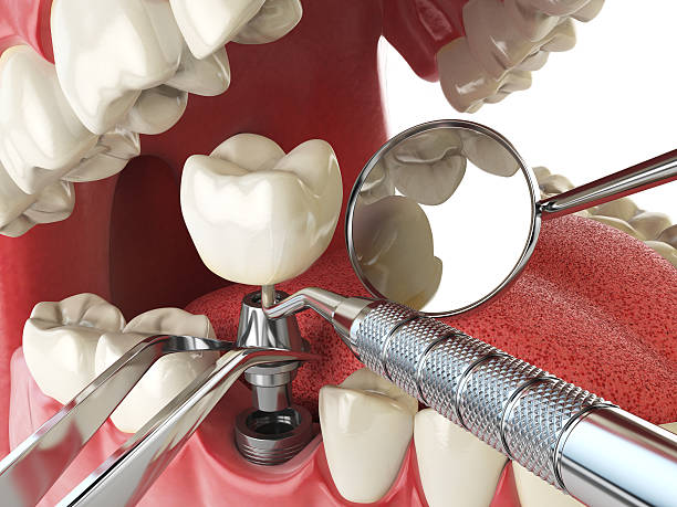 Best Emergency Tooth Extraction in Garfield, TX